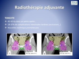 Radiothérapie adjuvante
TOXICITE
 45-50 Gy dans un pelvis opéré…
 18-37% de complications intestinales tardives (occlusions…)
 Nouvelles technique prometteuses
 
