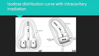 Isodose distribution curve with intracavitary
irradiation
 
