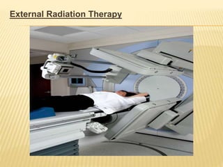 External Radiation Therapy
 