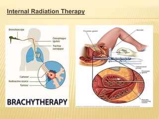 Internal Radiation Therapy
 