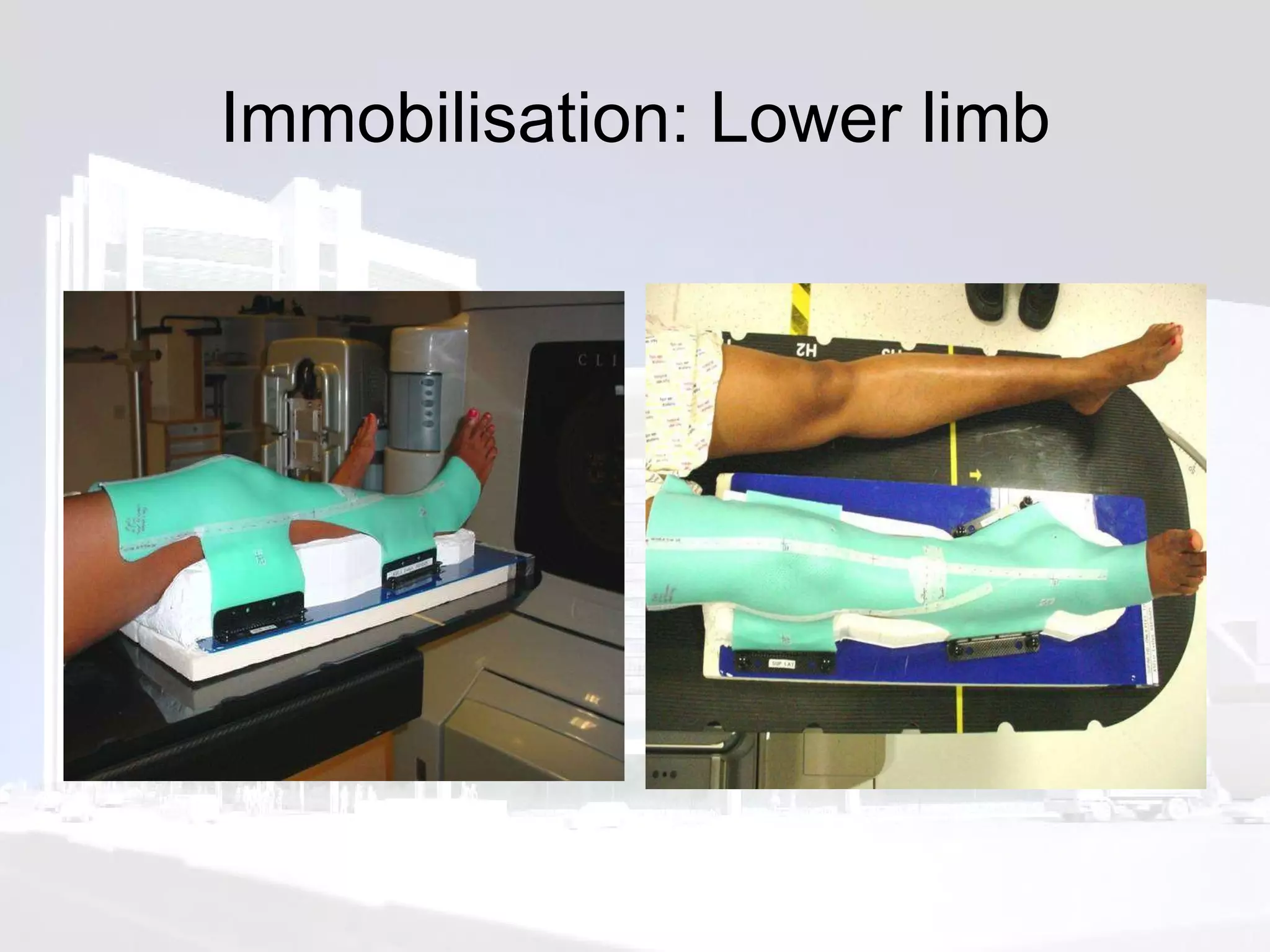 Immobilisation: Lower limb 