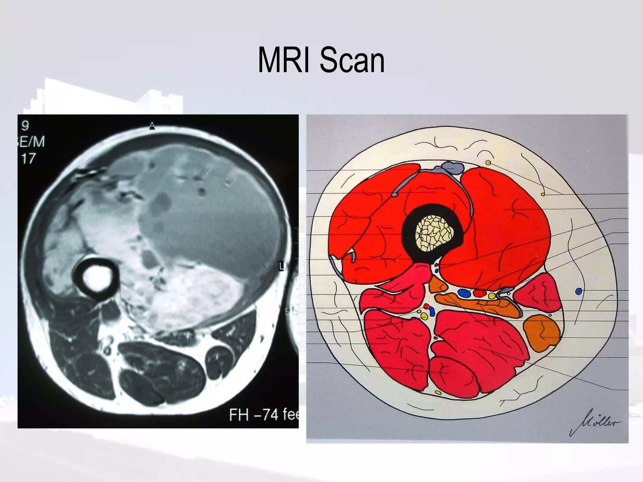 MRI Scan 