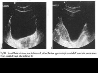 Radiotherapy for bladder cancer part i | PPTX