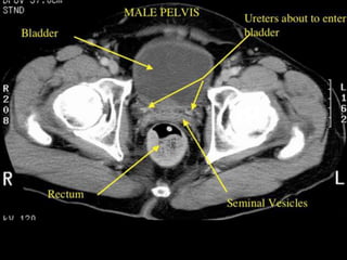 Radiotherapy for bladder cancer part i | PPTX