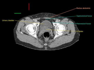 Radiotherapy for bladder cancer part i | PPTX