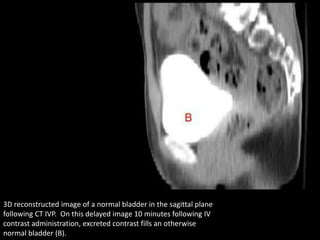 Radiotherapy for bladder cancer part i | PPTX