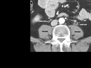 Radiotherapy for bladder cancer part i | PPTX