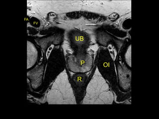 Radiotherapy for bladder cancer part i | PPTX