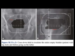 Radiotherapy for bladder cancer part ii | PPTX