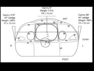 Radiotherapy for bladder cancer part ii | PPTX