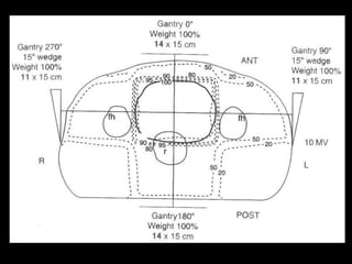 Radiotherapy for bladder cancer part ii | PPTX