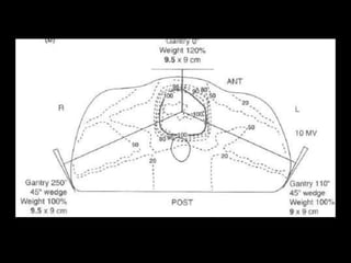 Radiotherapy for bladder cancer part ii | PPTX