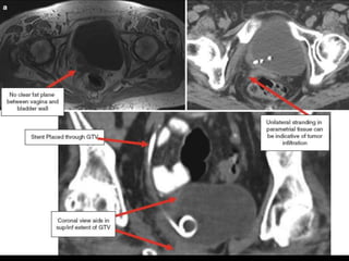 Radiotherapy for bladder cancer part ii | PPTX