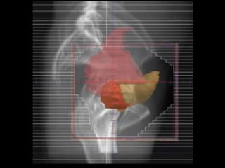Radiotherapy for bladder cancer part ii | PPTX