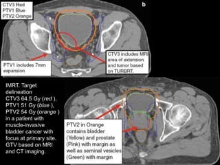 Radiotherapy for bladder cancer part ii | PPTX