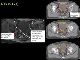 Radiotherapy for bladder cancer part ii | PPTX
