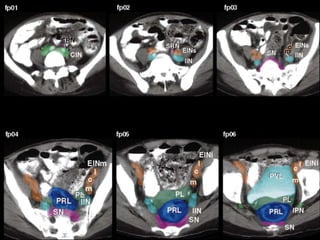 Radiotherapy for bladder cancer part ii | PPTX