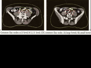 Radiotherapy for bladder cancer part ii | PPTX
