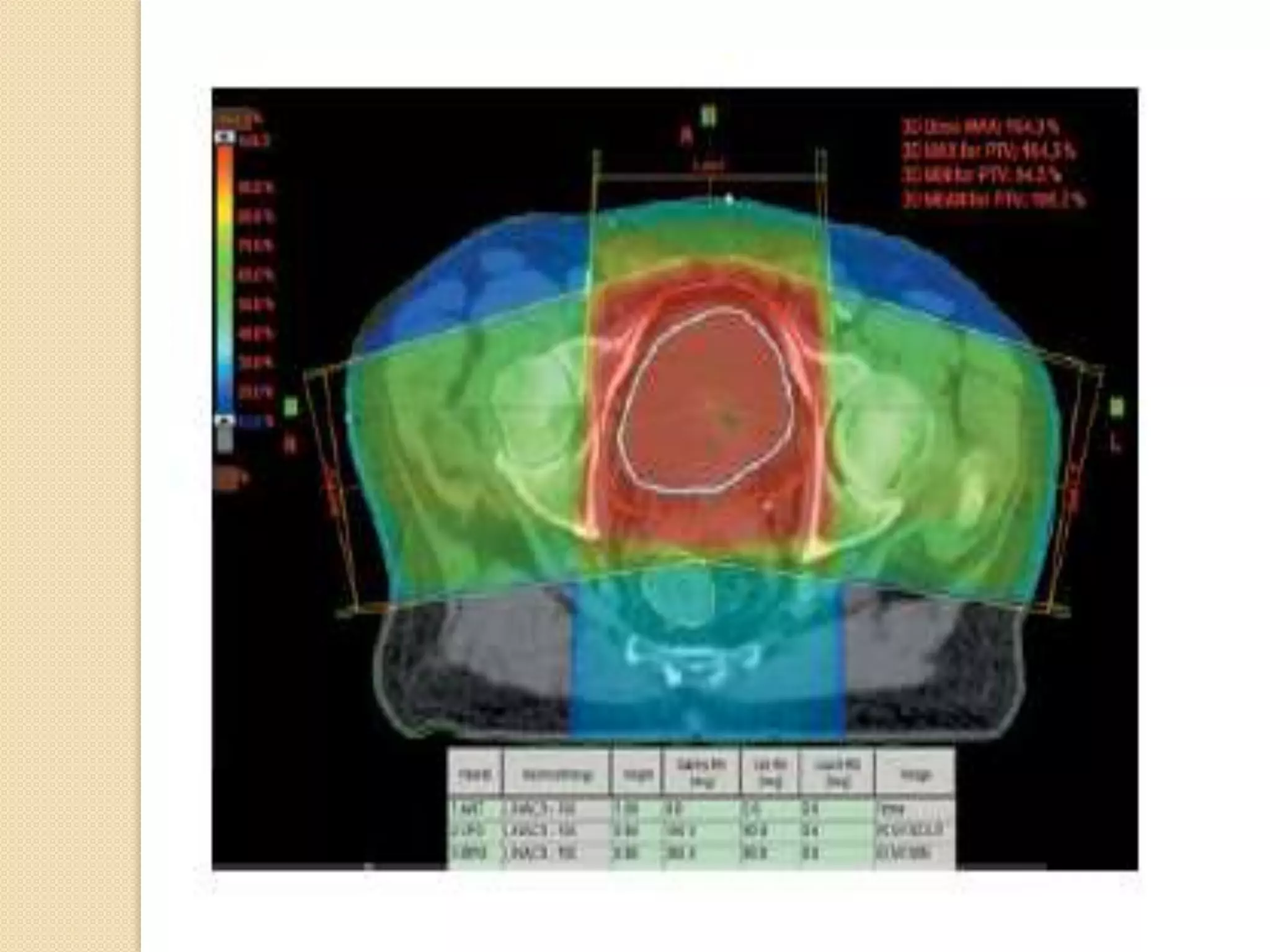 Radiotherapy for bladder cancers | PPTX