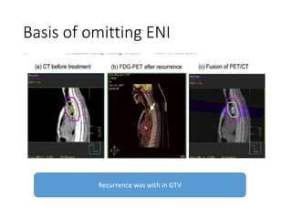 Basis of omitting ENI
Recurrence was with in GTV
 