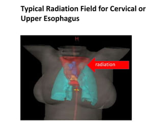 Typical Radiation Field for Cervical or
Upper Esophagus
radiation
 