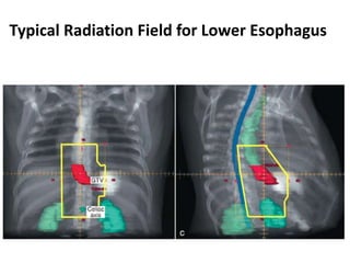 Typical Radiation Field for Lower Esophagus
 