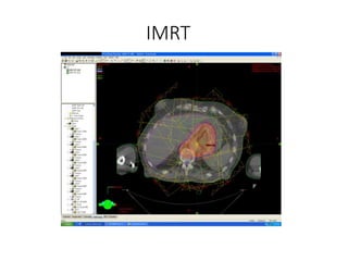 IMRT
 