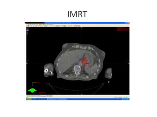 IMRT
 