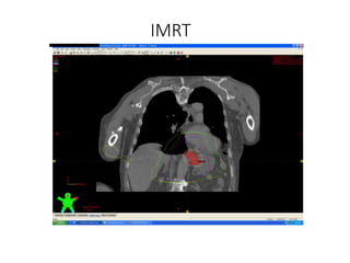 IMRT
 