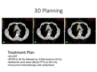 3D Planning
Treatment Plan
•3D-CRT
•AP/PA to 36 Gy followed by 3-field boost to 45 Gy
•Additional cone down (Boost PTV) to 50.4 Gy
•Concurrent chemotherapy with carbo/taxol
 