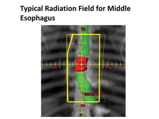 Typical Radiation Field for Middle
Esophagus
 