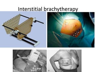 Interstitial Radiotherapy Radiotherapy in carcinoma breast | PPTX
