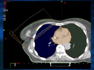 Radiotherapy In Carcinoma Of The Breast | PPT