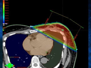 Radiotherapy In Carcinoma Of The Breast | PPT
