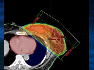 Radiotherapy In Carcinoma Of The Breast | PPT