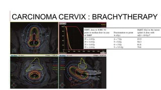 Radiotherapy in Gynaecology [Autosaved].pptx