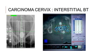 Radiotherapy in Gynaecology [Autosaved].pptx