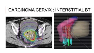 Radiotherapy in Gynaecology [Autosaved].pptx