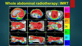 Current role of radiotherapy
 Salvage radiotherapy: isolated pelvic recurrences
 Palliative radiotherapy
 Intra-operati...