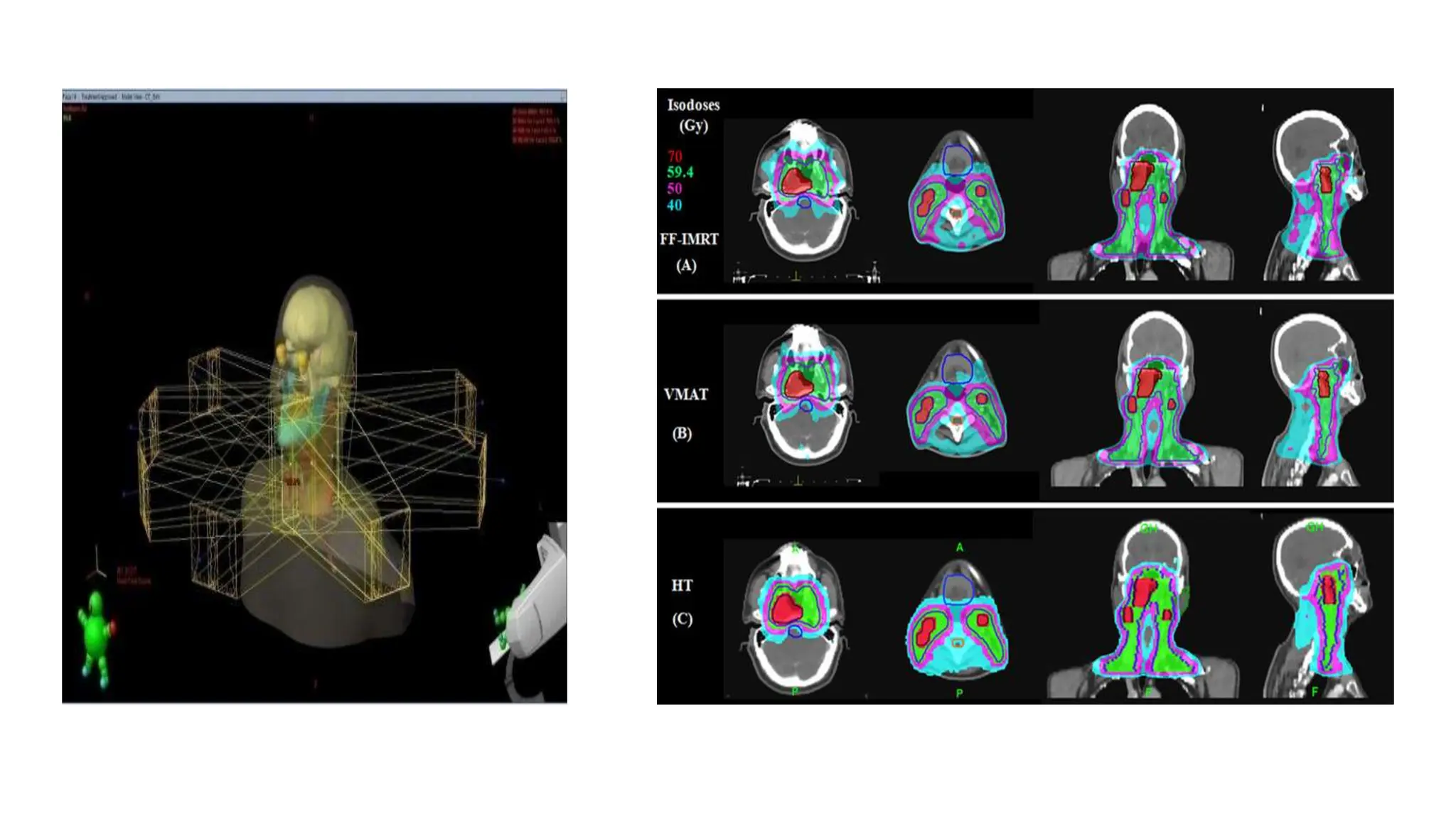 radiotherapy in head and neck cancers.pptx