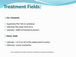 Treatment Fields:
 For Paraaortic
 Superiorly:The T10-11 vertebrae
 Inferiorly:The lower limit of L4
 Laterally : width of transverse process
 Pelvis Field:
 Laterally : 1.5-2 cm lat to the widest point in pelvis
 Inferiorly : Lesser trochanter.
Perez and Brady’s Principles and Practice of Radiation Oncology (sixth edition)
 