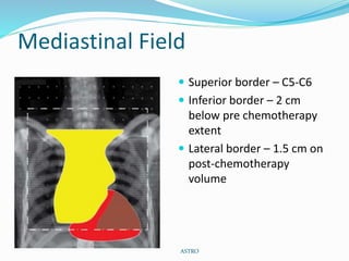 Mediastinal Field
 Superior border – C5-C6
 Inferior border – 2 cm
below pre chemotherapy
extent
 Lateral border – 1.5 cm on
post-chemotherapy
volume
ASTRO
 