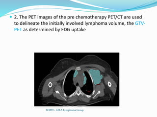  2. The PET images of the pre chemotherapy PET/CT are used
to delineate the initially involved lymphoma volume, the GTV-
PET as determined by FDG uptake
EORTC- GELA Lymphoma Group
 