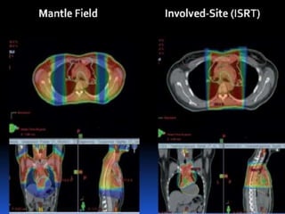  If no pre chemotherapy imaging is available
 To gather description of :
 The pre chemotherapy physical examination of the patient
 The location of scars and scar tissue on the post
chemotherapy planning CT scan
 The patient’s and the family’s recollections of the location
of the presenting lymph node(s)
 The CTV should be contoured taking into account all of this
information, making generous allowance for the many
uncertainties in the process
 