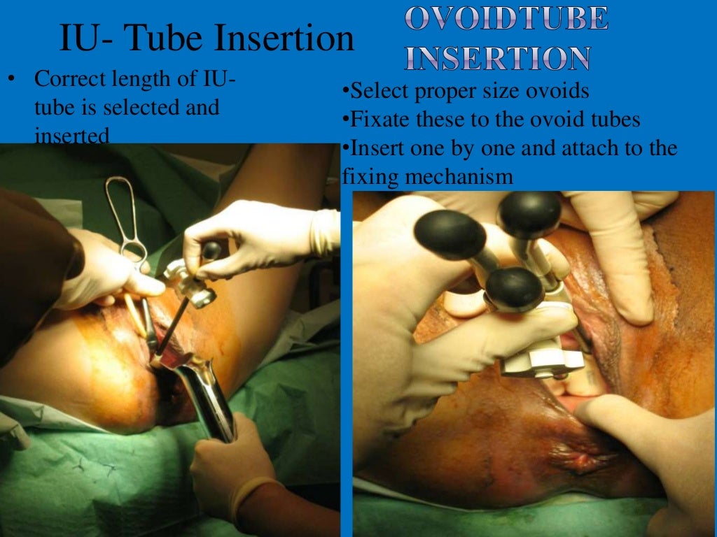 Radiotherapy of cervical cancer