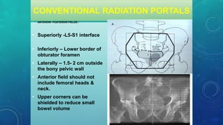 CONVENTIONAL RADIATION PORTALS
• ANTERIOR- POSTERIOR FIELDS :
• Superiorly -L5-S1 interface
• Inferiorly – Lower border of
obturator foramen
• Laterally – 1.5- 2 cm outside
the bony pelvic wall
• Anterior field should not
include femoral heads &
neck.
• Upper corners can be
shielded to reduce small
bowel volume.
 