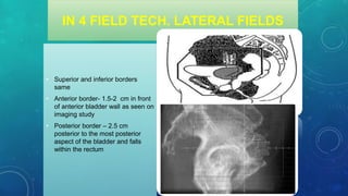 IN 4 FIELD TECH. LATERAL FIELDS
• Superior and inferior borders
same
• Anterior border- 1.5-2 cm in front
of anterior bladder wall as seen on
imaging study
• Posterior border – 2.5 cm
posterior to the most posterior
aspect of the bladder and falls
within the rectum
 