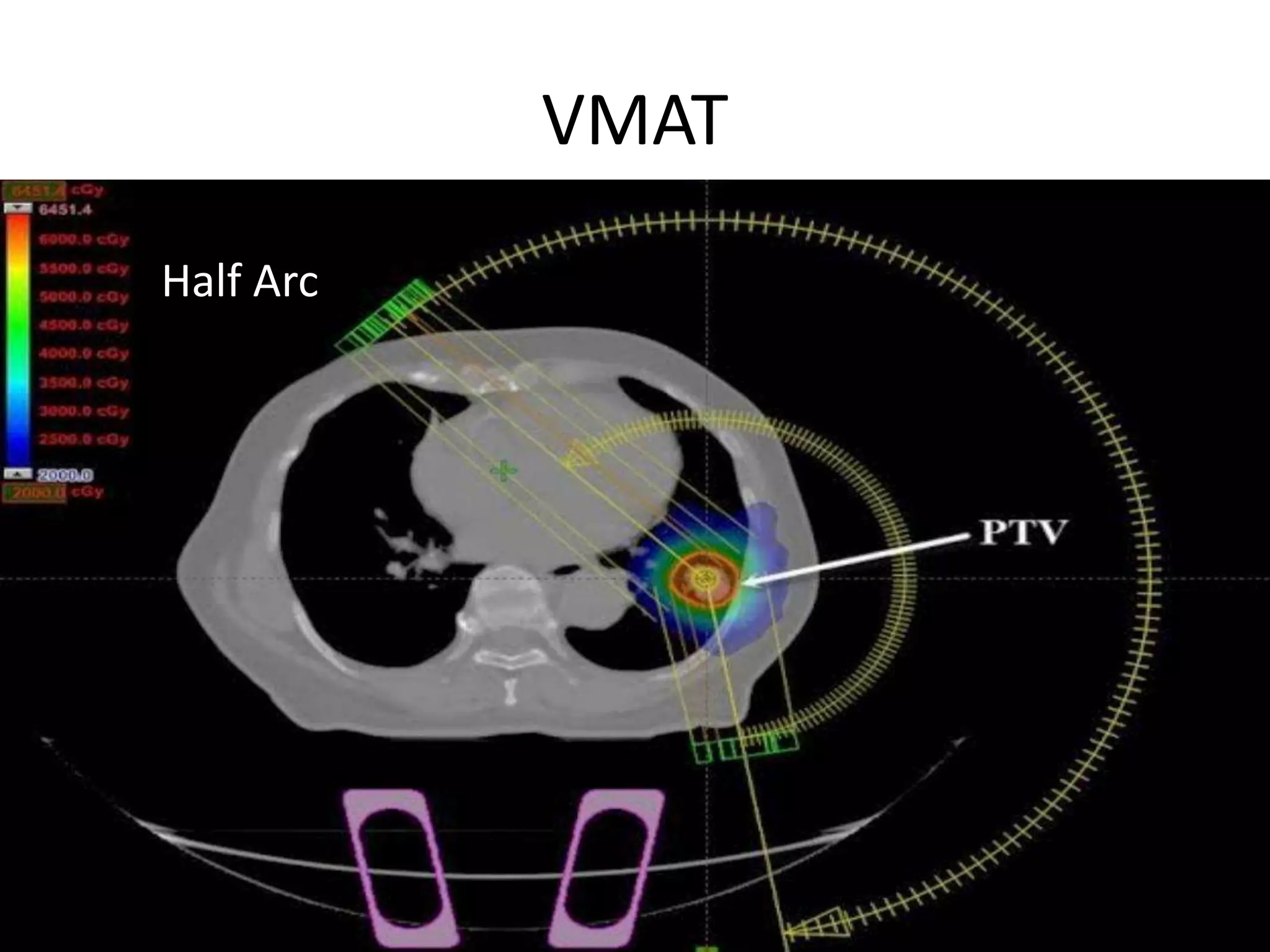 Radiotherapy Technique PPTX Radiotherapy Technique PPTX