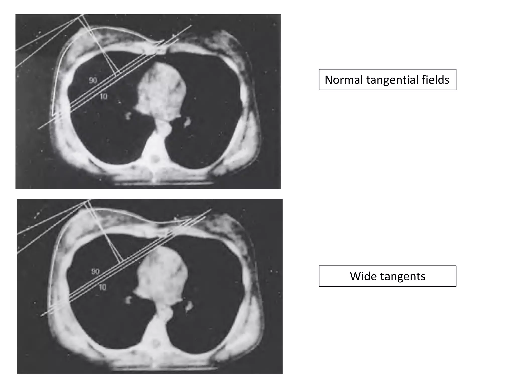 Tangential Projection Radiograph Radiotherapy techniques for Breast Cancer | PDF