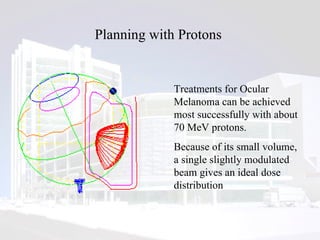Planning with Protons  Treatments for Ocular Melanoma can be achieved most successfully with about 70 MeV protons. Because of its small volume, a single slightly modulated beam gives an ideal dose distribution 